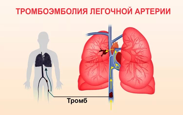 Тромбоэмболия легочной артерии. Тромбоэмболия легочной артерии (Тэла). Эмболия легочных сосудов. Оторвался тромб в легких