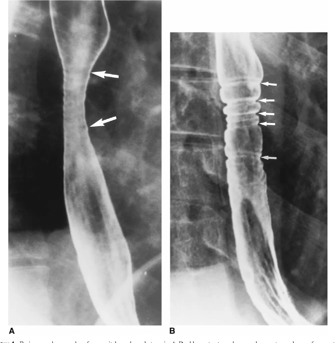 Рубцовые сужения пищевода. Пептический стеноз пищевода. Стеноз пищевода рентгенограмма. Стеноз пищевода рентген. Бужирование пищевода рентген.
