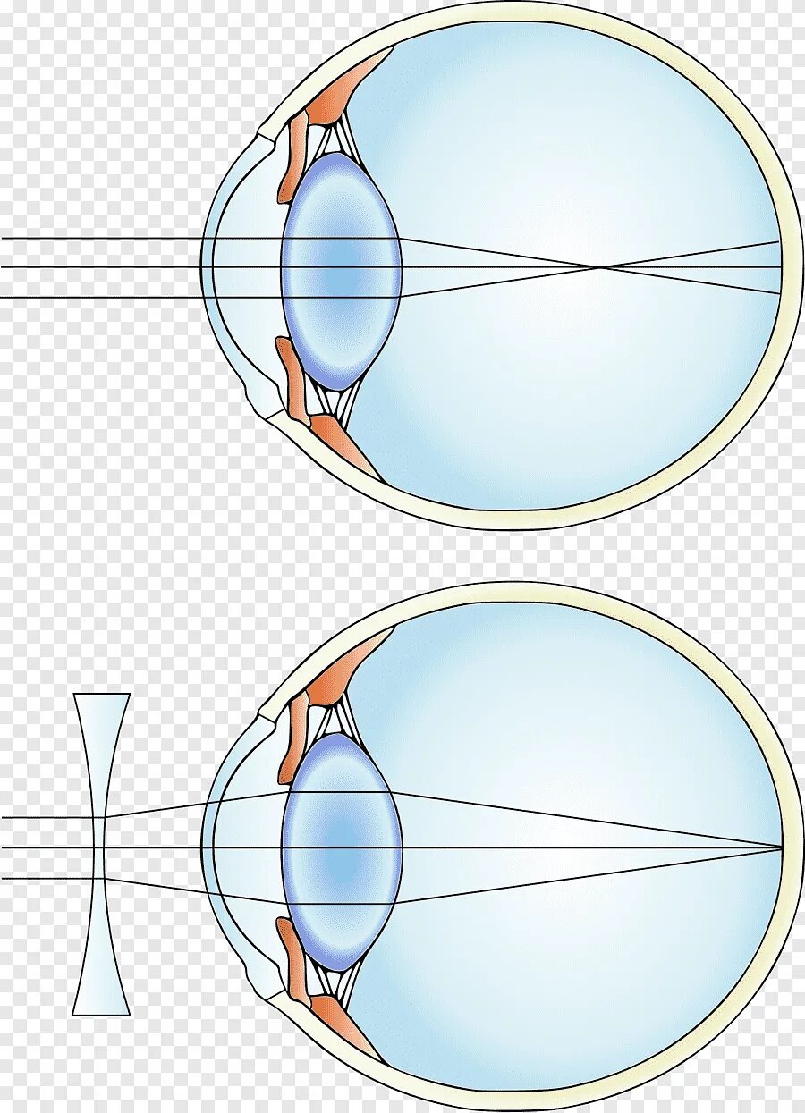 Фокусировка лучей света на внутренней поверхности глазного. Миопия дальнозоркость астигматизм. Миопия двояковогнутые линзы. Близорукость и дальнозоркость сетчатка. Двояковогнутая линза для близорукости.