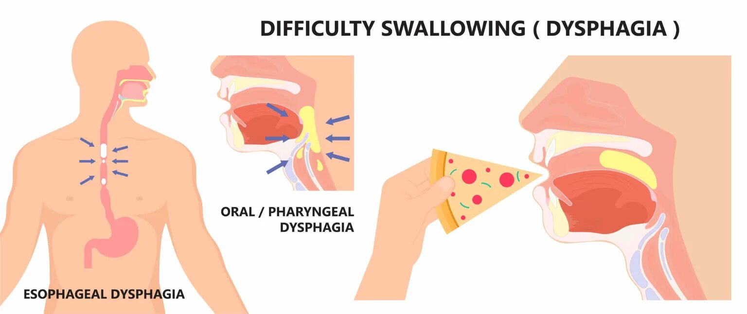Ротоглоточная дисфагия. Еда застревает в пищеводе