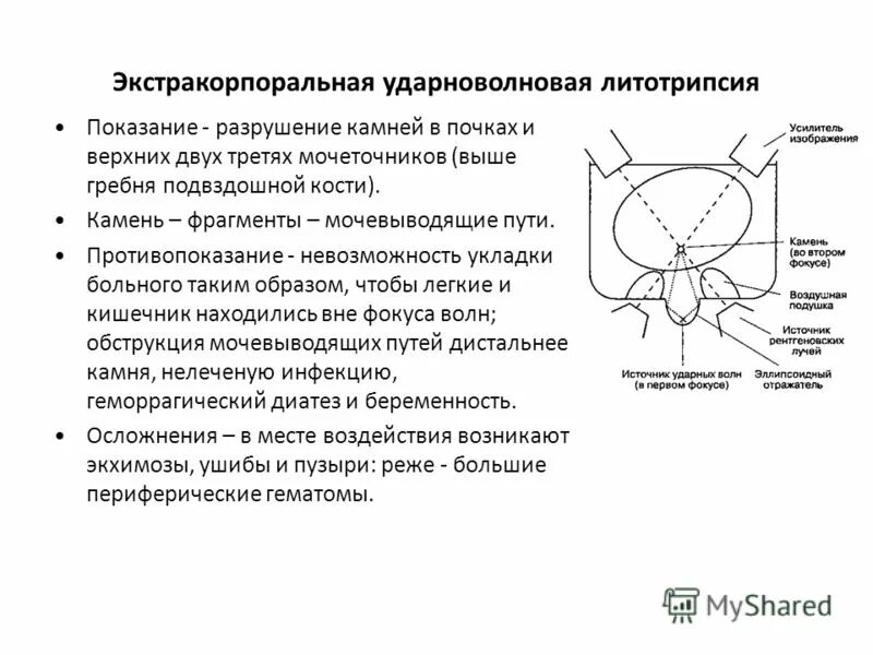 Литотрипсия камней в желчном пузыре