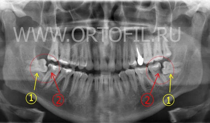 Зуб 8 нижний. Разрушение зуба мудрости. Зубы восьмерки на снимках. Зуб восьмерка разрушился. Корень зуба мудрости рентген.