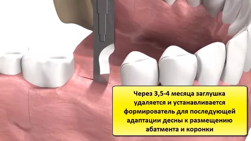 Через сколько можно вставлять зубы. Этапы постановки коронок на зубы. Имплантат и формирователь десны. Имплантация зуба формирователь десны.