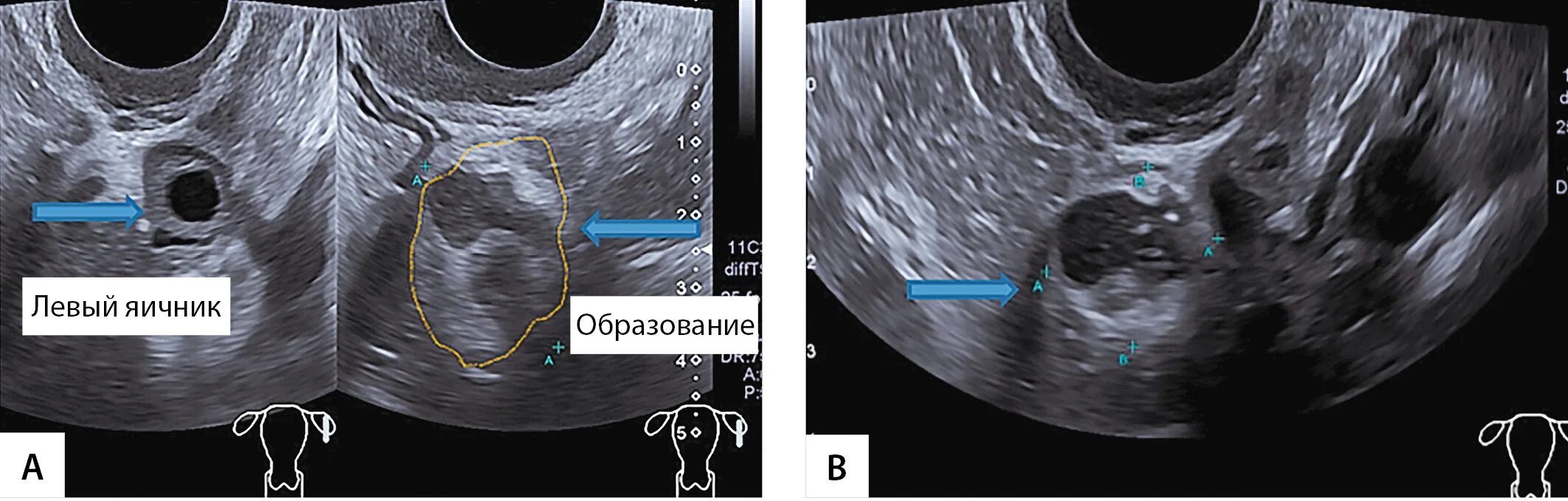 Что образуется в яичниках. Образования яичников на УЗИ.