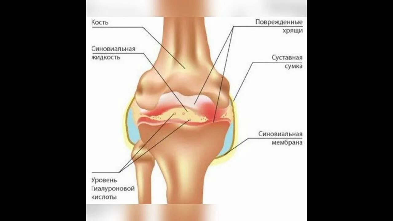 Хрустят суставы что принимать