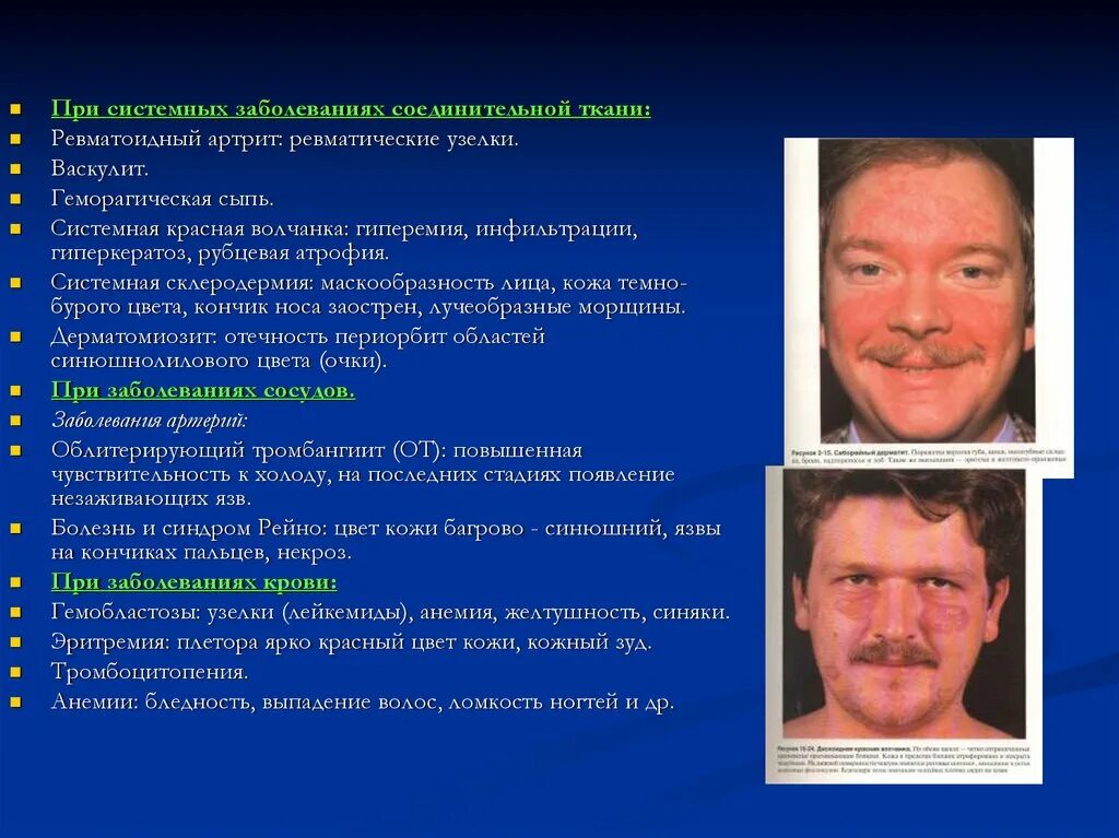 Системное заболевание соединительной склеродермия. Системная красная волчанка склеродермия. Дискоидная красная волчанка клиника. Системная красная волчанка на лице. Красная волчанка ревматоидный артрит