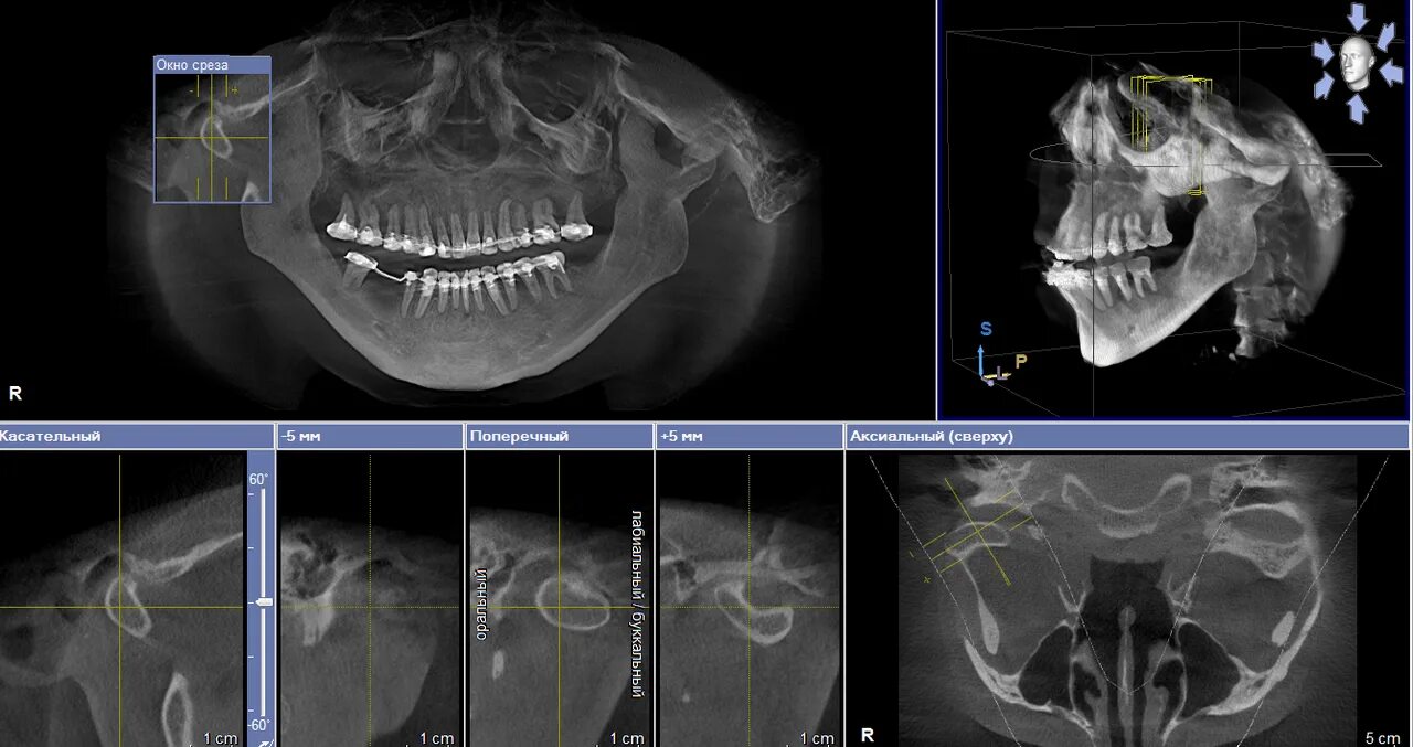Кт суставов челюсти ВНЧС. Planmeca Romexis кт ВНЧС. Кт д т