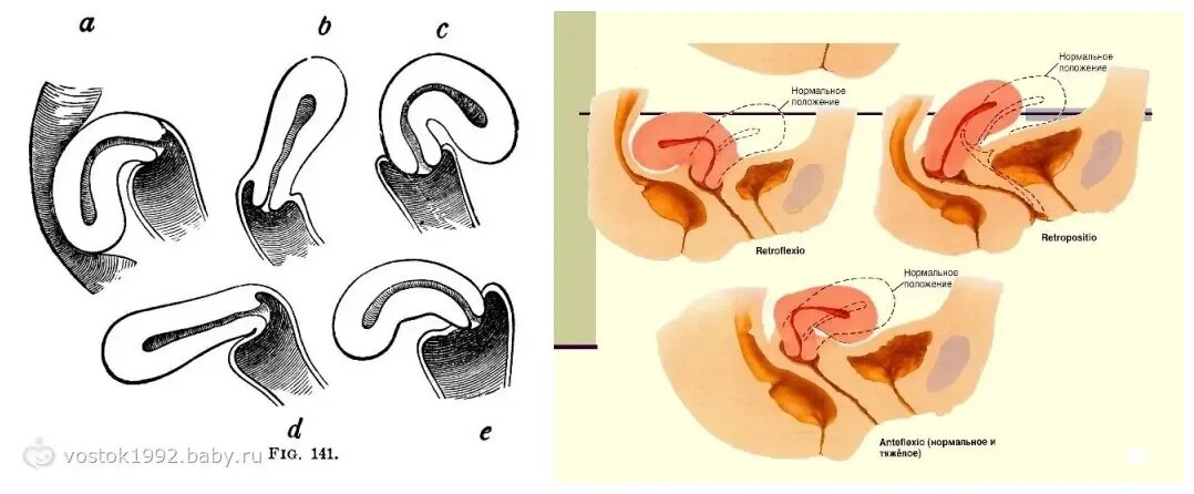 Перегиб матки anteflexio. Расположение шейки матки кзади. Антефлексио положение матки что это. Загиб матки кзади. Изгиб шейки