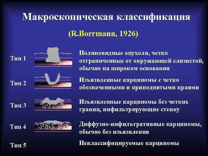 Опухоли виды классификация. Классификация желудка. Опухоли желудка классификация. Эндоскопическая классификация опухолей желудка.