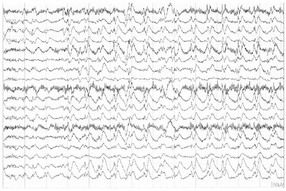 Диффузные эпилептиформные. Эпилептиформная активность на ЭЭГ. Пик медленная волна на ЭЭГ что это. Острая медленная волна. Разряд эпилептиформной активности.