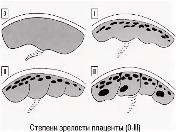 Преждевременное созревание плаценты