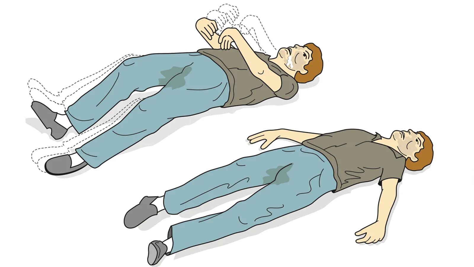 Приступы без судорог. Приступы без судорог. Эпилептический приступ. Припадок эпилепсии симптомы. Эпилептический припадо.