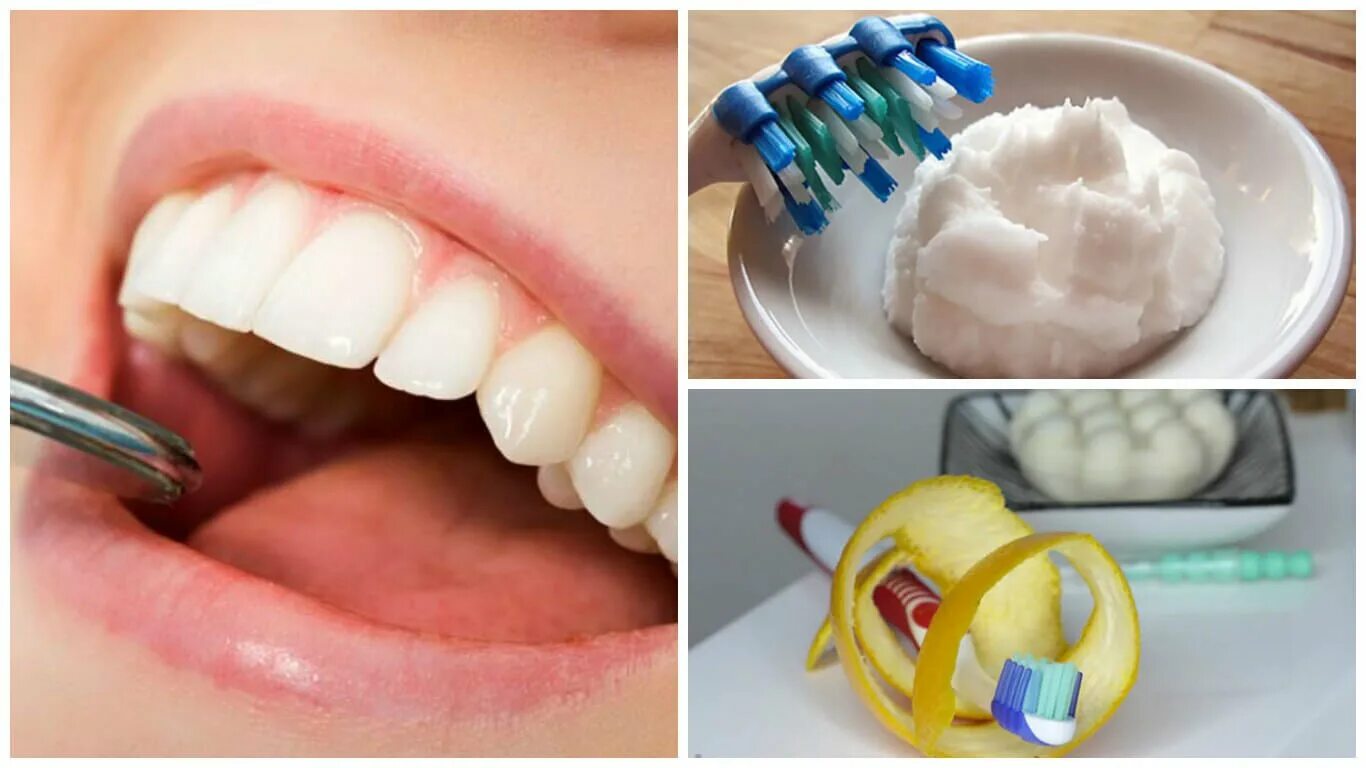 Как удалить зубную в домашних условиях. Отбеливание зубной камень.