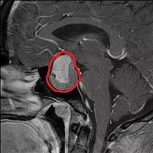 Формирующееся турецкое седло в головном мозге