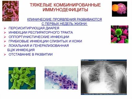 Тяжелая иммунная недостаточность