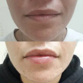 Асимметрия после увеличения