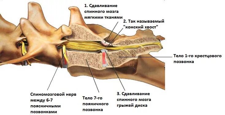 Крестцовый стеноз. Пояснично-крестцовый стеноз у собак. Люмбосакральный стеноз у собак.