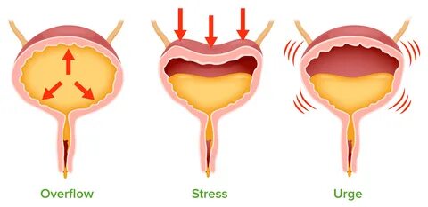 Urinary Incontinence (Clinical) Concise Medical Knowledge