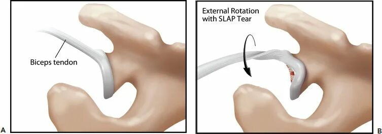 Slap повреждение плечевого сустава. Классификация slap повреждения. Slap-повреждения губы гленоида.