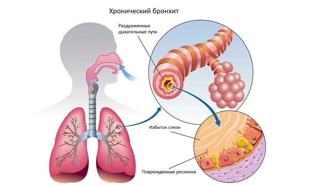 Бронхит латынь. Хронический бронхит исход. Профилактика бронхита картинки.