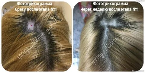 Фолликулярный юнит