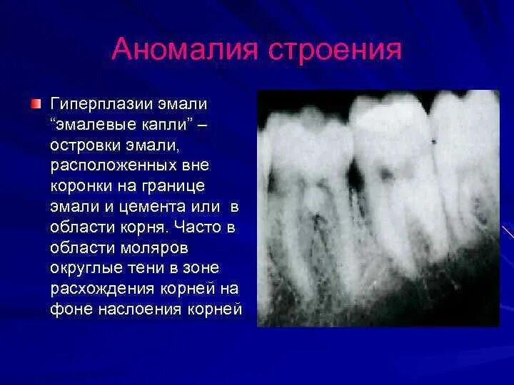 Основные клинические формы гиперплазии зубов:. Гиперплазия эмали зубов.