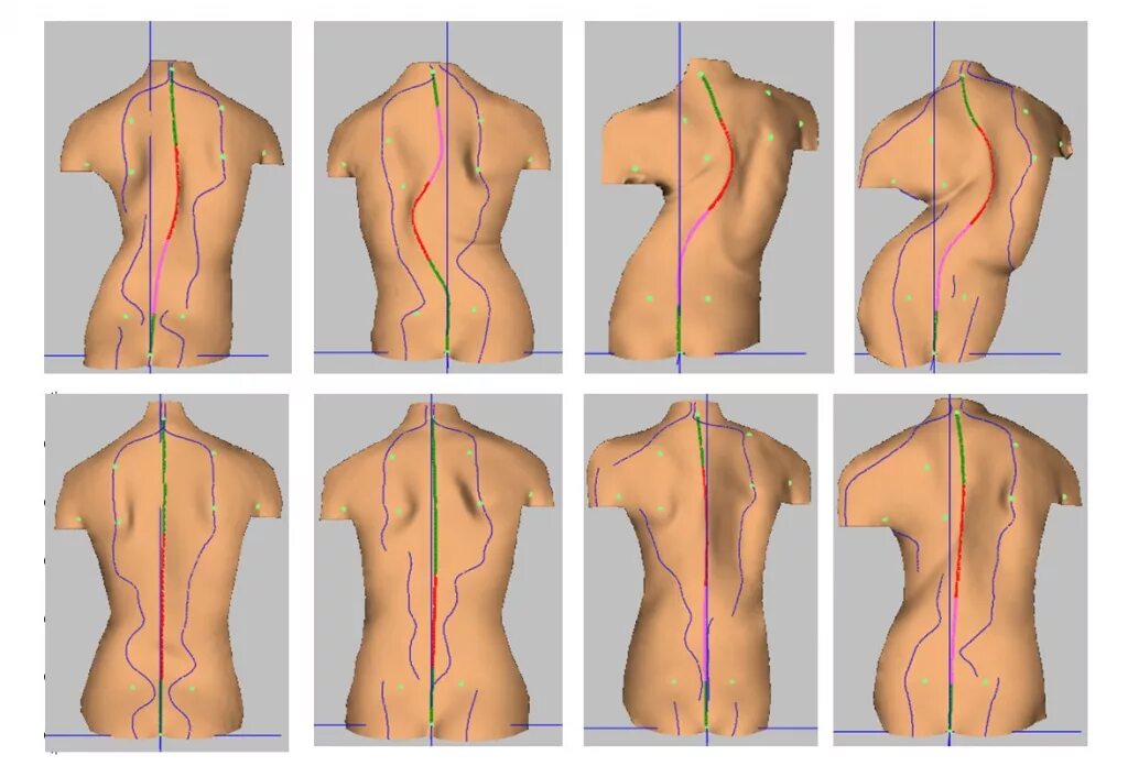Идиопатический грудопоясничный сколиоз 3 степени. Сколиотическая деформация шейного отдела позвоночника 1 степени. Идиопатический грудопоясничный сколиоз 1 степени. S образный сколиоз грудного отдела степени.