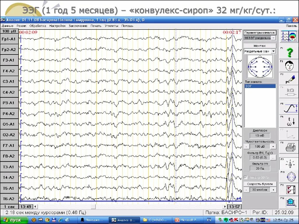 Ээг 10 10. Схема ЭЭГ 10-20. 19 Каналов ЭЭГ схема. Электроэнцефалография. Анализ электроэнцефалограммы. ЭЭГ ВМ.