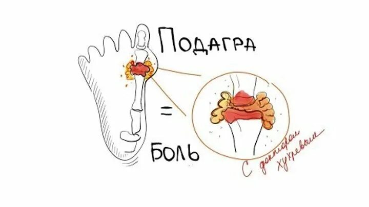 Подагра болезнь королей. Подагра болезнь аристократов. Полагра болезнь аристократо. Почему болезнь королей