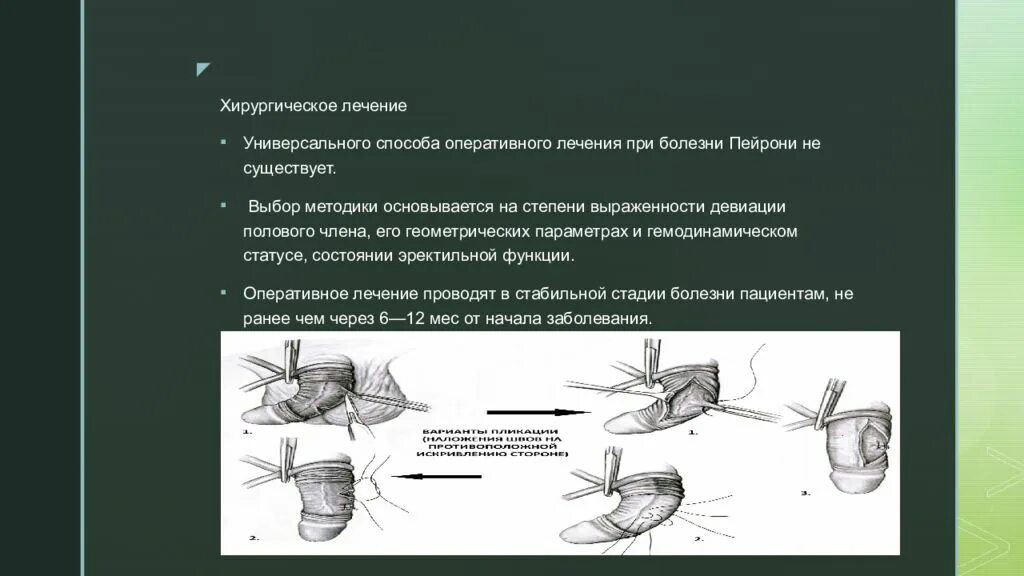 Половой орган у мужчины причины. Пейрони болезнь лечение. Болезнь Пейрони полового члена. Кавернозный фиброз или болезнь Пейрони.