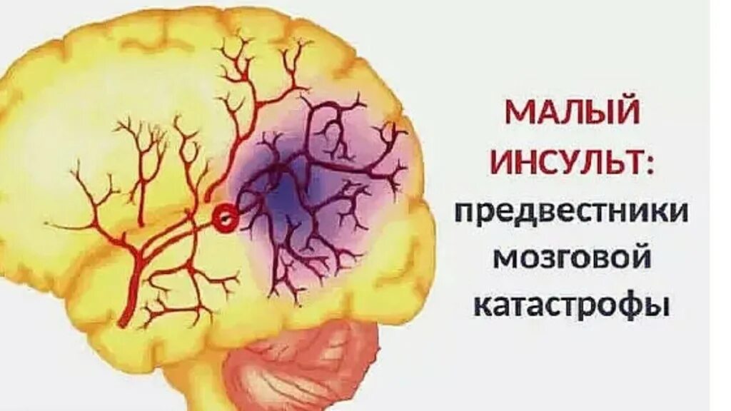 Инсульт. Малый инсульт. Малый ишемический инсульт. Предвестники инсульта. Головной микроинсульт