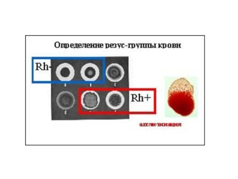 Определение резус фактора крови. Определение резус фактора экспресс методом. Группа крови и резус. Золотая кровь группа крови и резус-фактор. Кровь без резуса