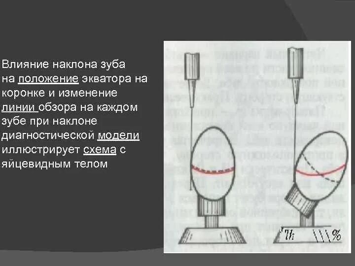 Клинический экватор зуба. Расположение межевой линии. Линия обзора в ортопедической стоматологии это. Анатомический экватор зуба. Клинический экватор зуба.