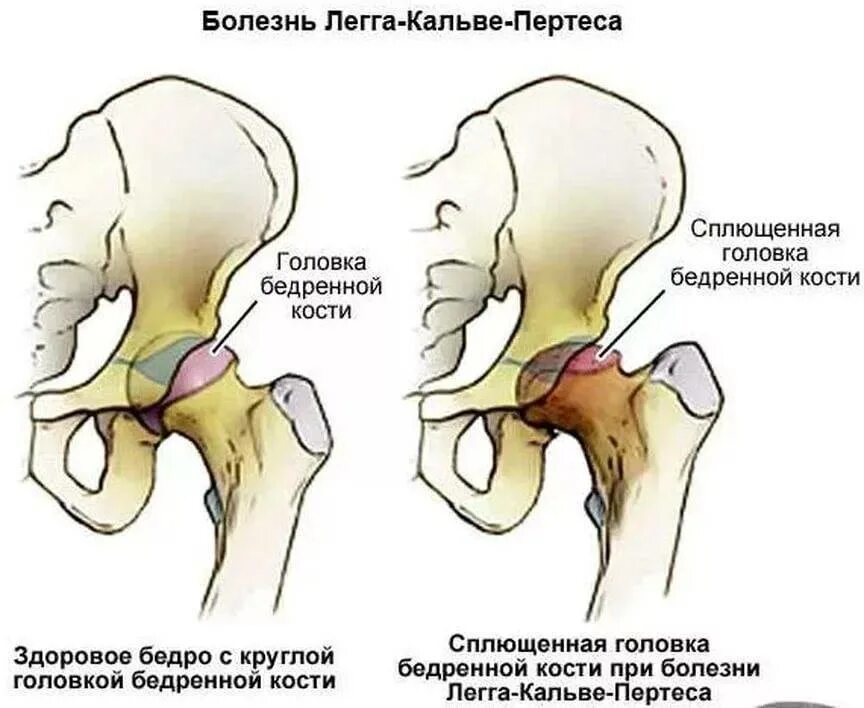 Болезни тазобедренного сустава у детей