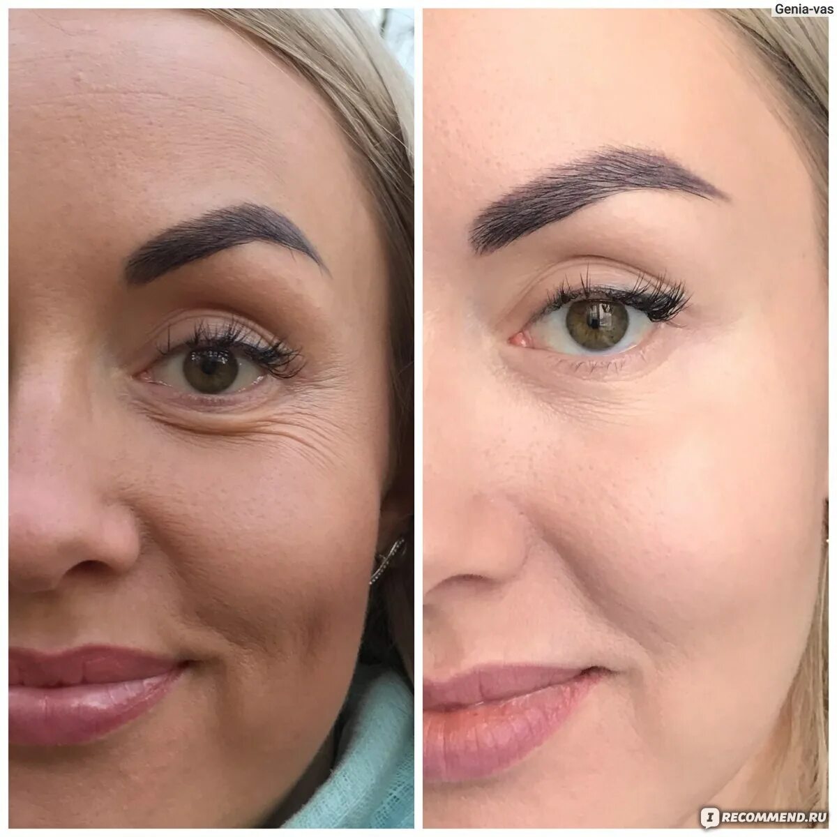 How to Cover Acne, Scars, Redness and Dark Circles: Flawless Makeup Tutorial - Y