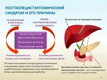 Приступ после удаления желчного пузыря