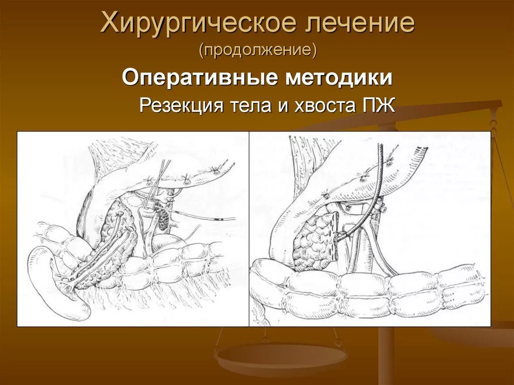 Хирургическое лечение острого панкреатита. Острый панкреатит операция. Методы дренирующих операций при остром панкреатите. Операции при остром панкреатите.