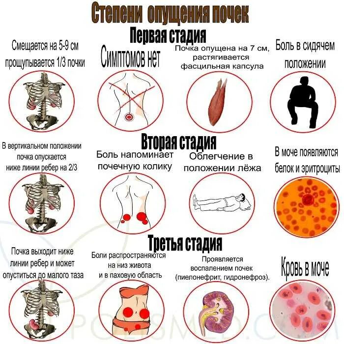 Нефроптоз почки 1 степени. Нефроптоз 1 степени справа. Нефроптоз почек 2 степени. Степени опущения почек. Боли при опущении почки