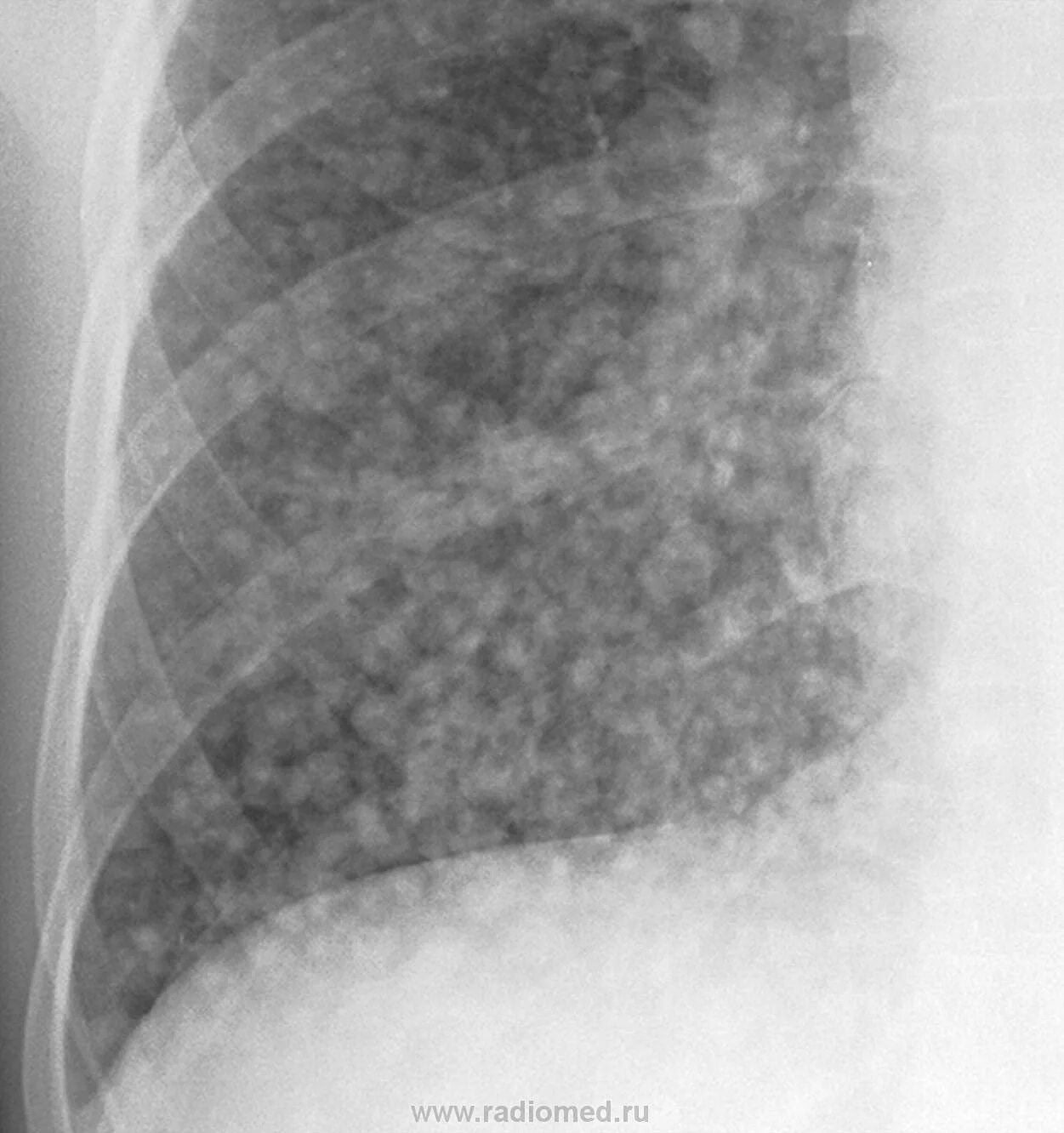 Лимфогенный туберкулез. Милиарный канцероматоз. Милиарный канцероматоз легких. Милиарный карциноз рентген.