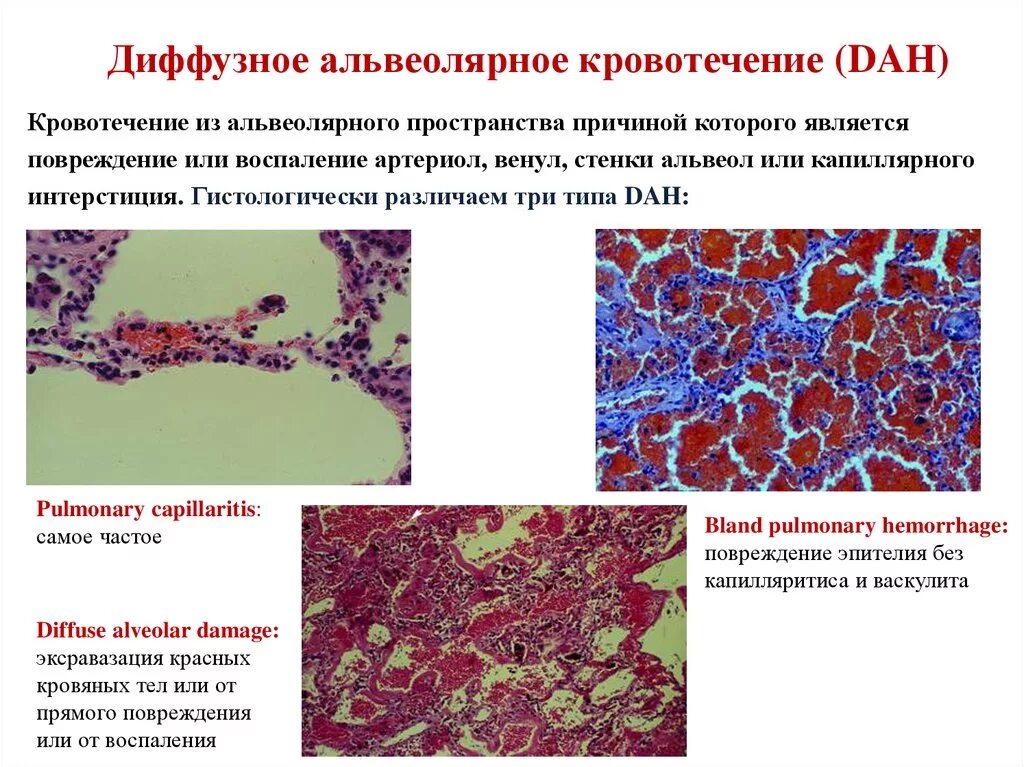 Диффузные л. Диффузное альвеолярное повреждение морфология. Диффузная альвеолярная геморрагия. Стадии диффузного альвеолярного повреждения. Диффузное альвеолярное кровоизлияние.