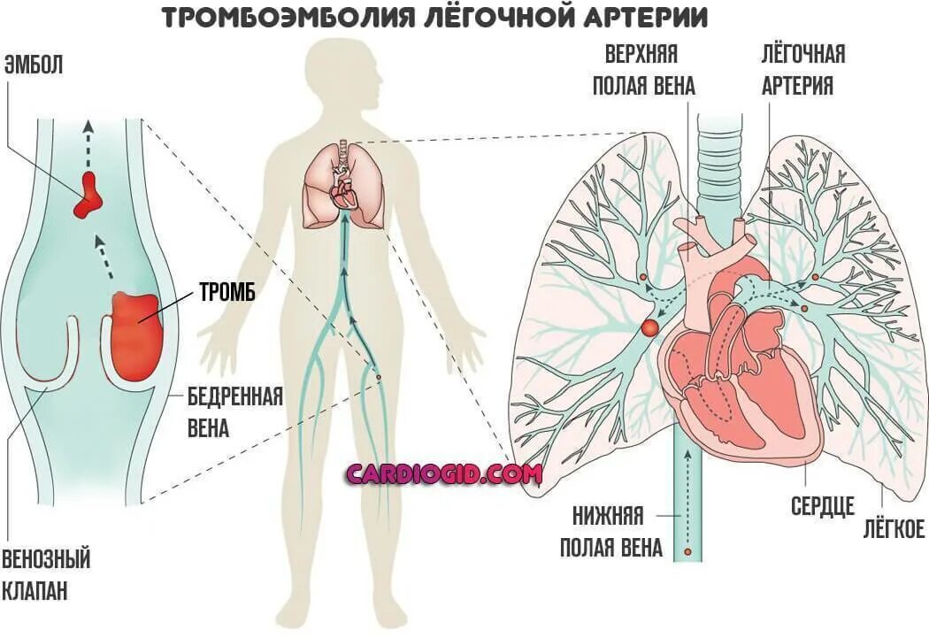 Тромбоэмболия крупных ветвей легочной артерии. Тромб в легочной артерии симптомы. Эмболия тромбом легочной артерии (Тэла);. Тромбоэмболия ветвей легочной артерии симптомы. Тромболия легочной артерии