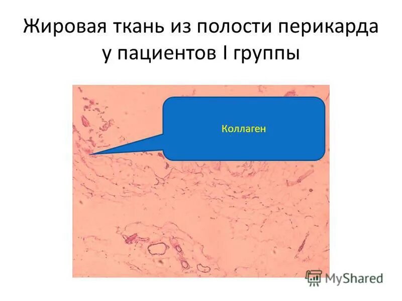 изменение жировой ткани. изменение жировой ткани. целлюлит строение жировой ткани. липоматоза подкожной жировой клетчатки. целлюлит в разрезе.