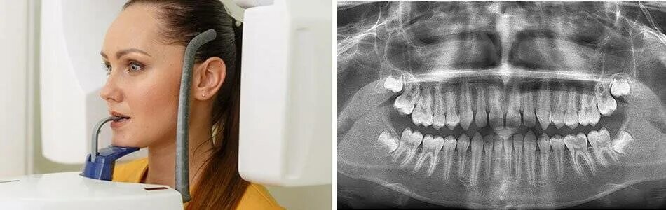 Рентген можно сделать. Ортопантомография ВНЧС. Внутриротовая длиннофокусная рентгенография. Внутриротовые снимки зубов.
