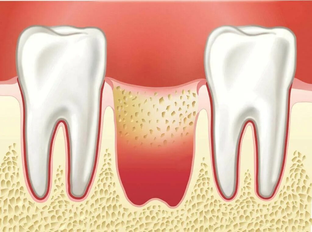 Альвеолита зубной лунки. Альвеолит альвеолит лунки зуба. Ольволит сухая лункп. Зуб после простуды
