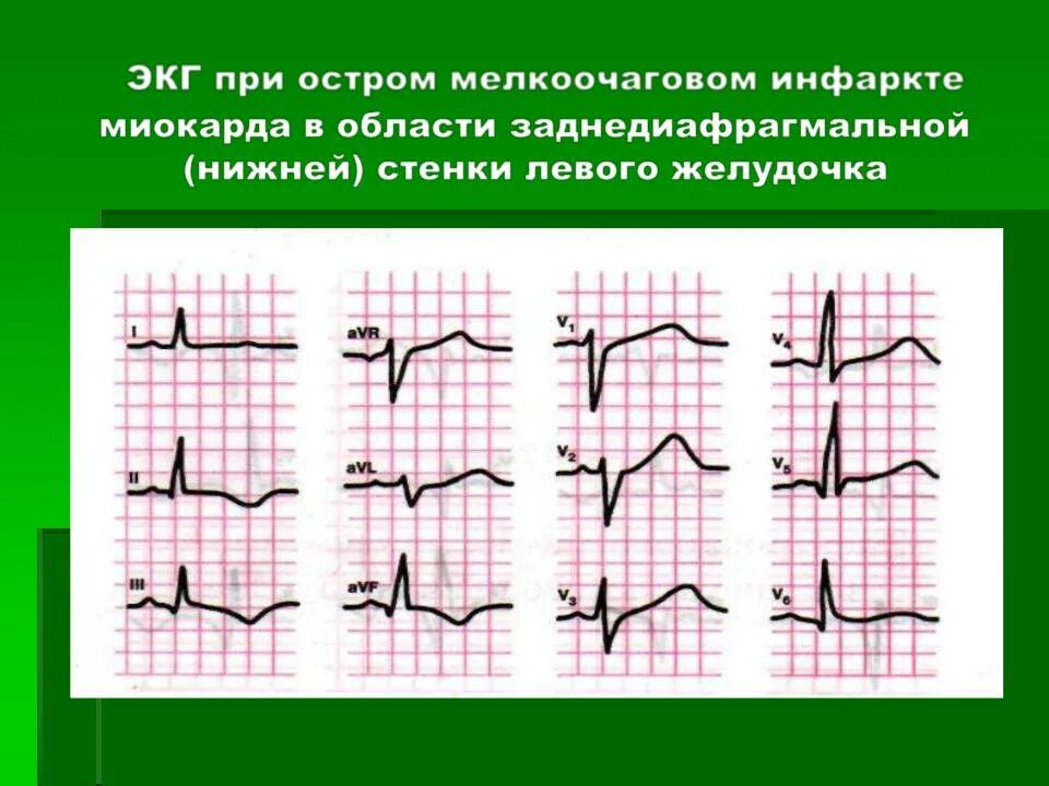 Изменения в нижней стенке левого желудочка. Острый инфаркт миокарда передней стенки ЭКГ. Острый инфаркт миокарда нижней стенки на ЭКГ. Мелкоочаговый Нижне-боковой инфаркт миокарда на ЭКГ. Острый боковой инфаркт миокарда ЭКГ.