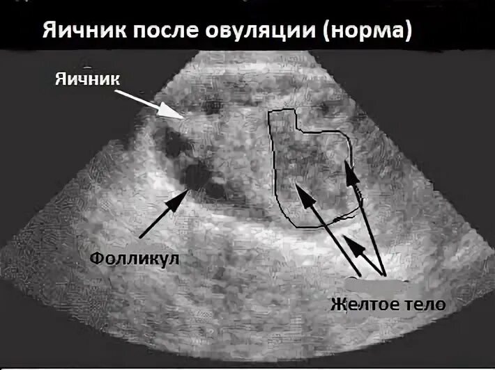 Прикрепление после овуляции. Жёлтое тело в яичнике на УЗИ. Яичники на УЗИ норма.