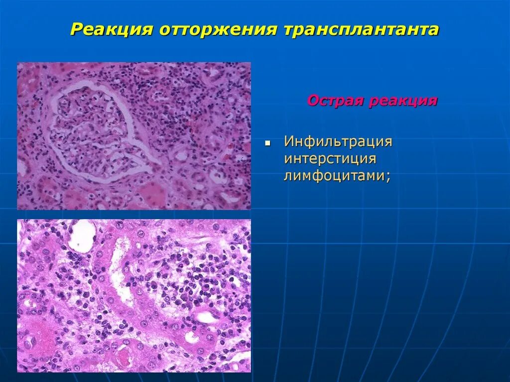 Трансплантант. Отторжение трансплантата патанатомия. Реакция отторжения трансплантата. Реакция отторжения трансплантата патологическая анатомия. Острейшая реакция отторжения трансплантата.