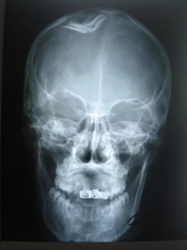 Сотрясение кости. Рентген черепа сотрясение мозга. Снимок сотрясение мозга рентгеновский головного мозга. Рентген скуловой кости. Перелом затылочной кости рентгенография.