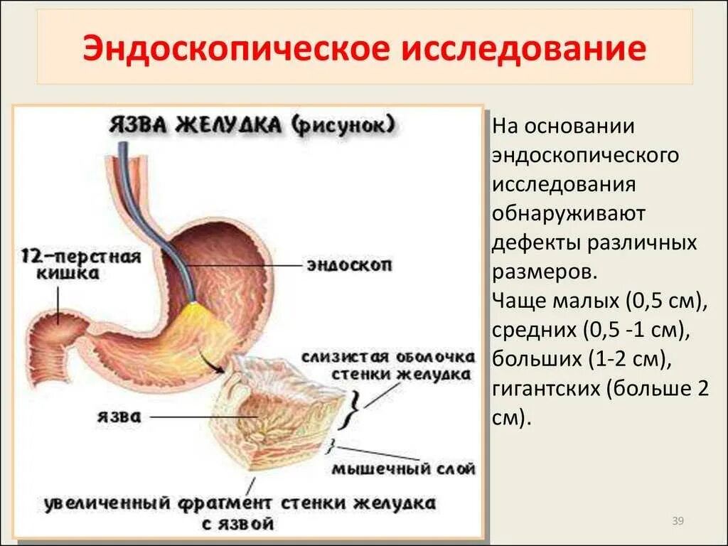 Терапия язвенной болезни 12 перстной кишки. Язвенная болезнь желудка и 12 перстной. Основные симптомы язвенной болезни желудка и 12-перстной кишки. Язвенная болезнь 12 перстной кишки симптомы. Лечение язвы желудка у взрослых