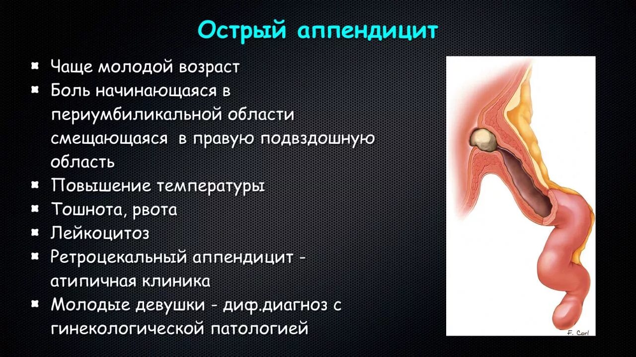 Можно ли назвать травмой аппендицит. Аппендикс воспалился симптомы. Симптомы воспаления аппендицита. Симптомы при аппендиксе. Причины воспаления аппендикса.